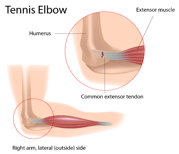 Anatomy of tennis elbow showing extensor muscle and common extensor tendon on the right arm.